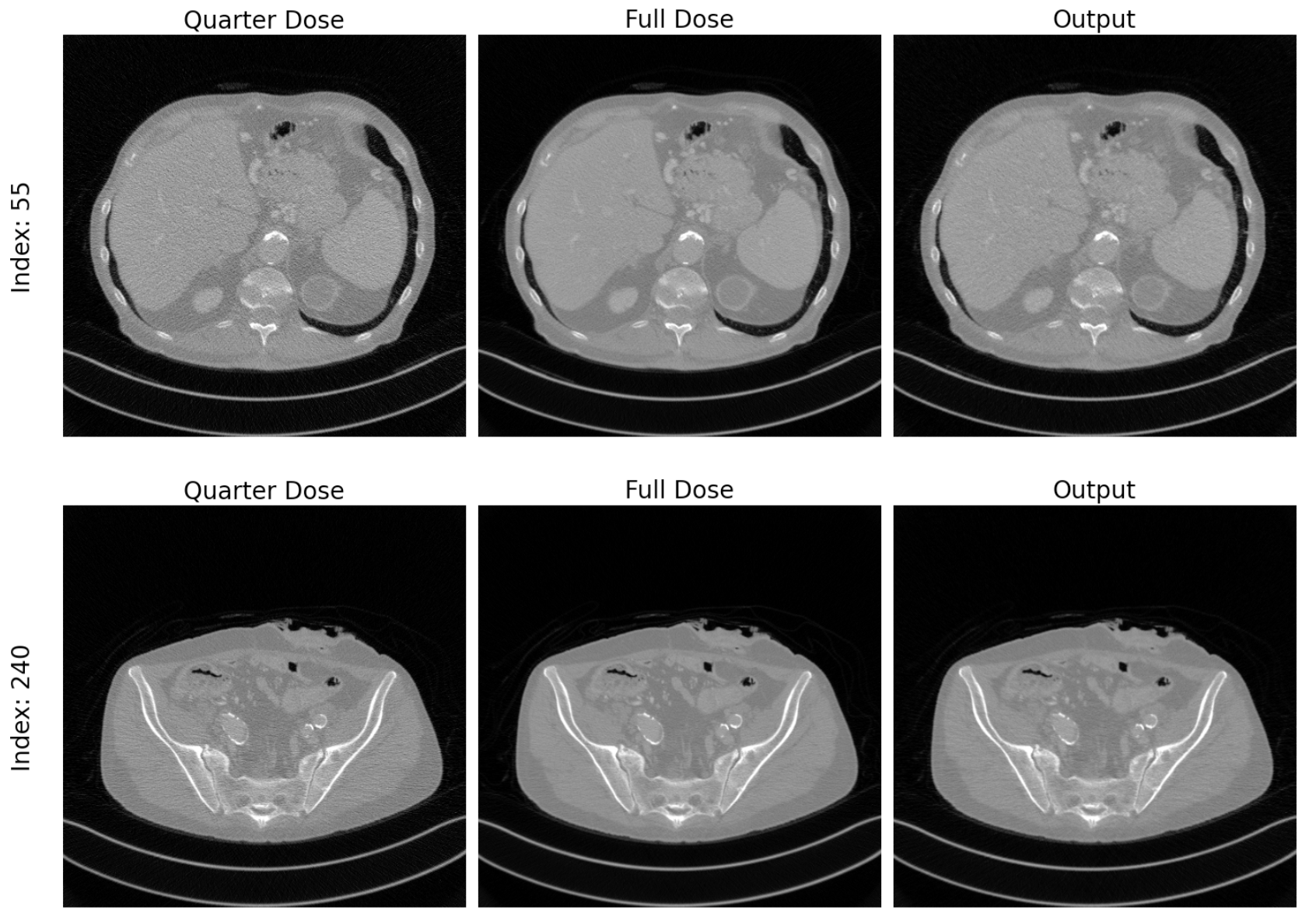 CT Denoising CycleGAN